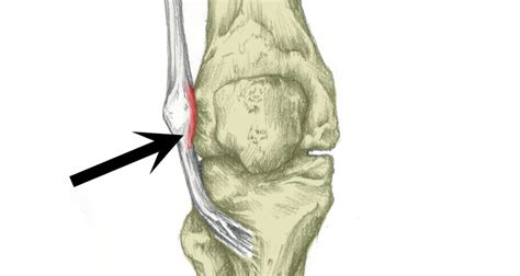 itb friction syndrome treatment